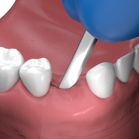 Surgical Procedure