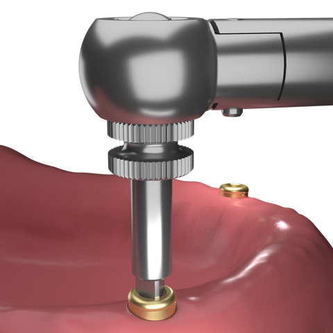 Placement of Positioner Denture Retaining Abutment