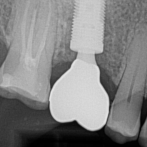 Placement of Abutment and Cement Retained Restoration