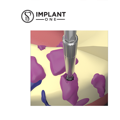 Open Tray Impressions Procedure