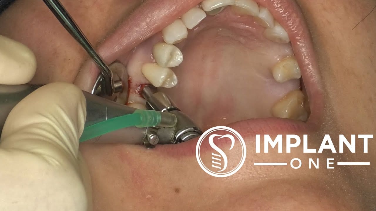 Bi-lateral Guided Surgery with Implant One Implants