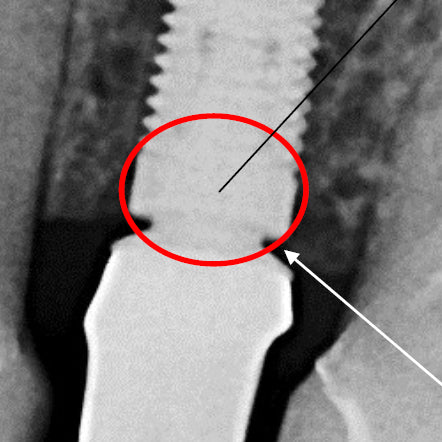 Proper Seating of an Implant One Abutment