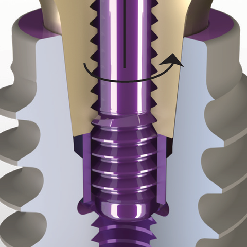 Abutment Removal Procedure