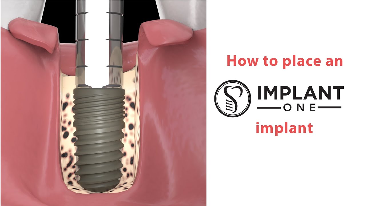How to Place an Implant One Implant, Animated