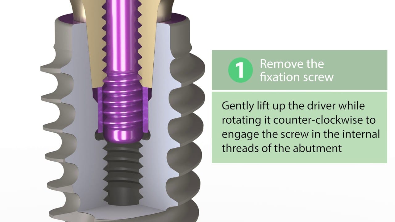 Abutment Removal Procedure, Animated