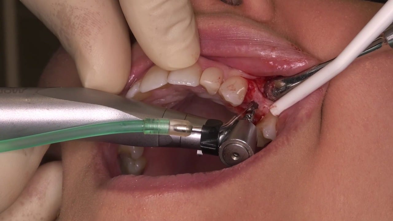 Single Tooth Implant, Non-guided