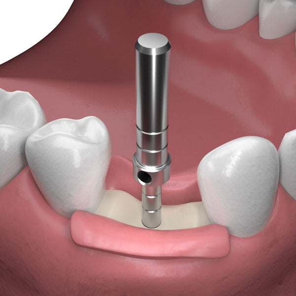 Implant One Parallel Pin