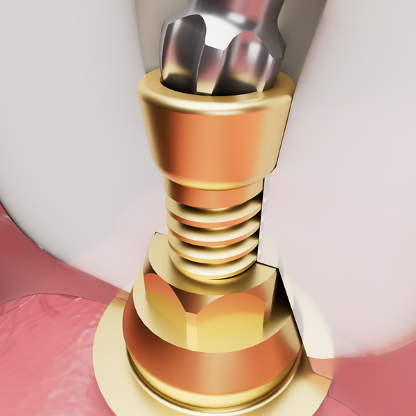 Vortex™ 1.6mm Direct-to-MUA screw