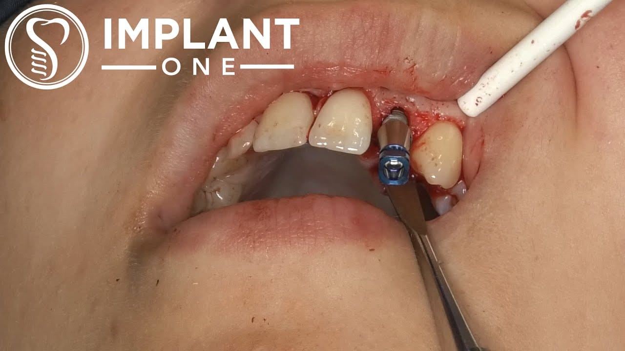 Anterior Non guided Surgery with Implant One Implants