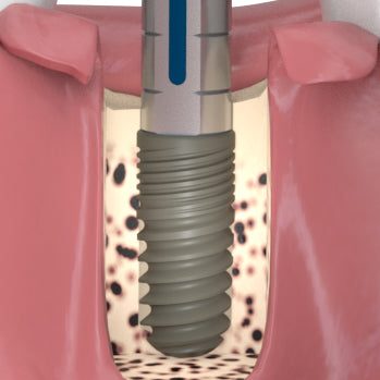 Final Placement of Implant