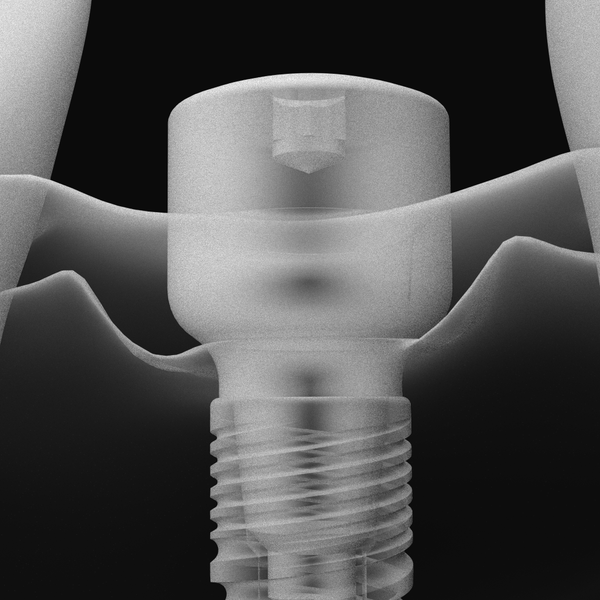 Implant One Procedure Sheets
